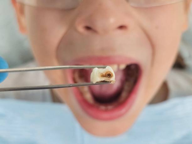 Best Emergency Dental Care for Abscessed Tooth in Powhatan Point, OH